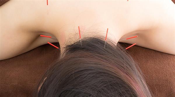 中醫(yī)針灸有何療效？石家莊炎黃針灸推拿學(xué)校為你分享！